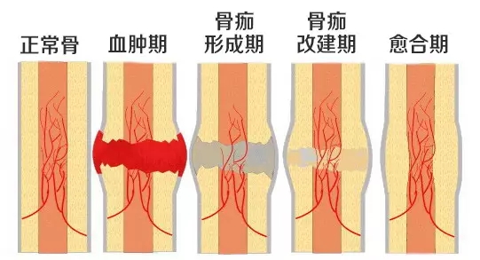 因为要形成骨痂,人体对钙,磷,胶原蛋白的需要比正常人多得多