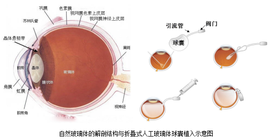 市眼科中心成功开展全市首例折叠式人工玻璃体球囊植入术