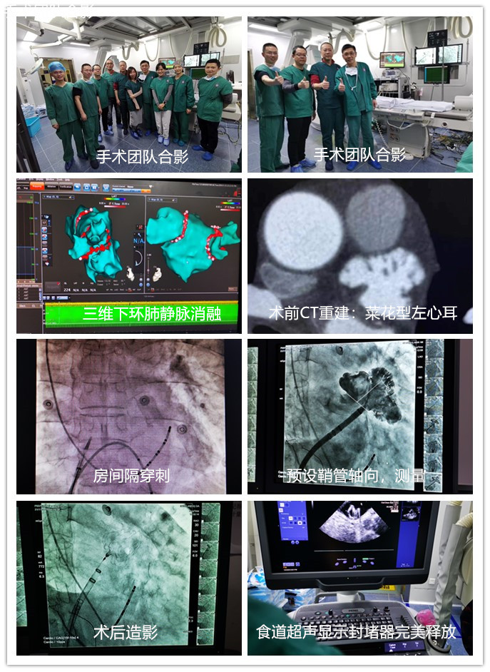 我院心血管內科成功開展樂山首例一站式房顫三維射頻消融左心耳封堵術