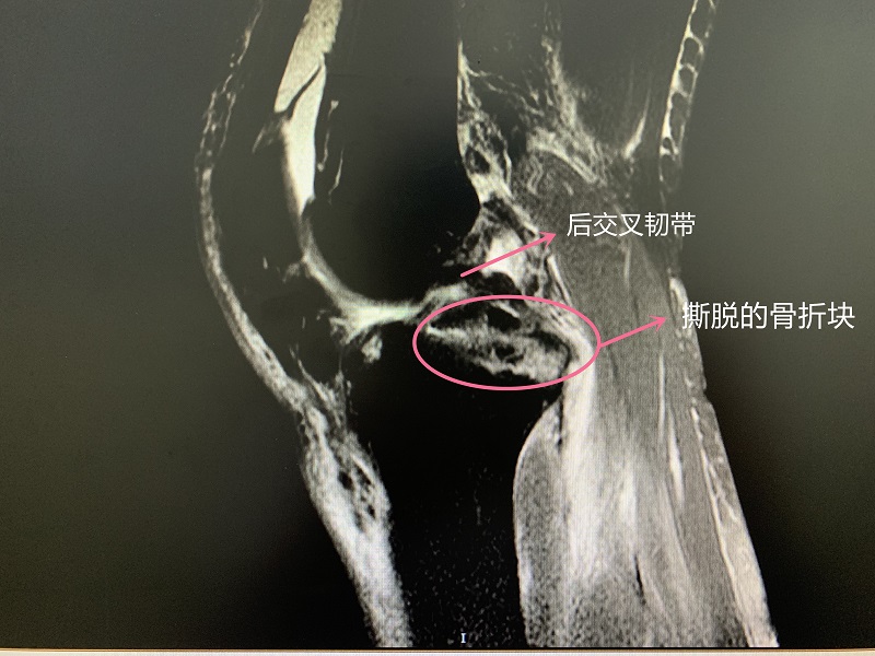 关节外科成功救治膝后交叉韧带胫骨止点撕脱骨折患者