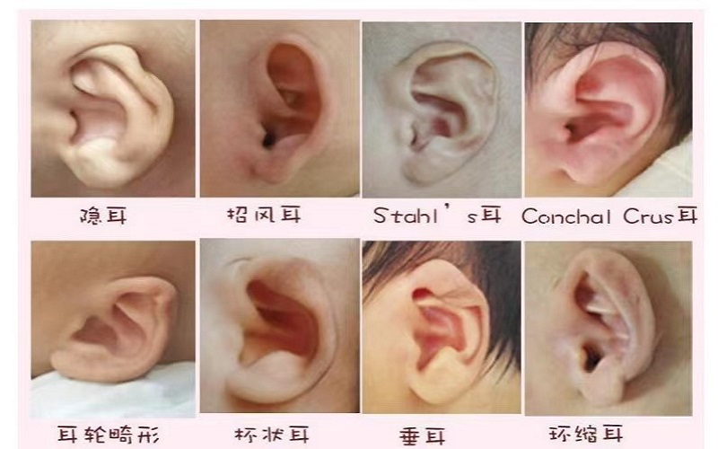 耳廓畸形.jpg 耳廓畸形.jpg