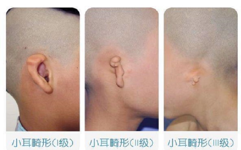 小耳畸形.jpg 小耳畸形.jpg