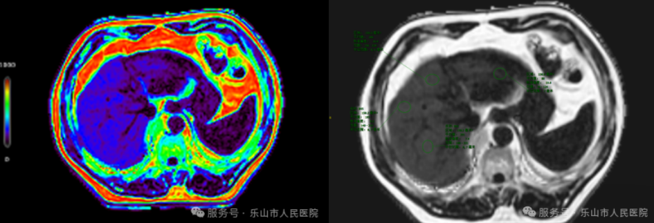 MRI肝脏.png MRI肝脏.png