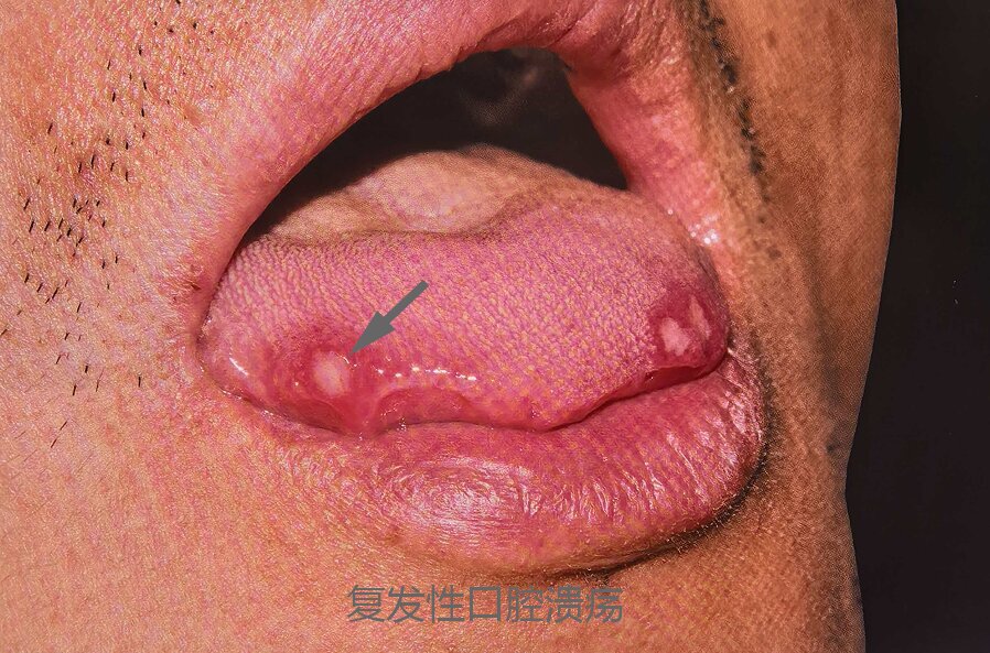 轻型复发性阿弗他溃疡.jpg 轻型复发性阿弗他溃疡.jpg